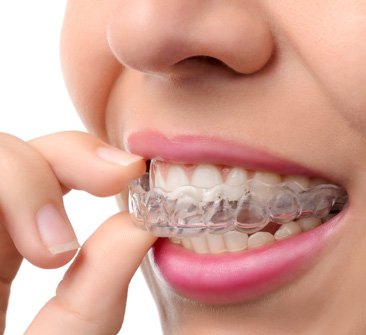 Aesthetic Braces